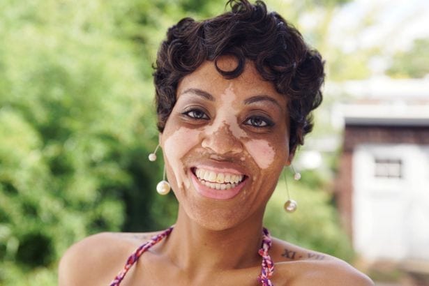 Atteinte du vitiligo, Takeisha Archbald assume sa peau et en est fière