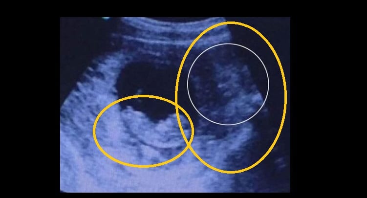 Est-ce vraiment un démon qui surveille ce bébé dans l'utérus de sa mère? (PHOTOS)