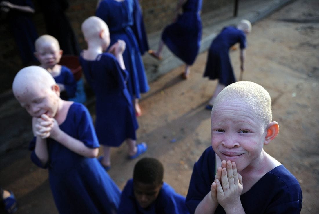 Tanzanie : des albinos vendus à 75 000 euros