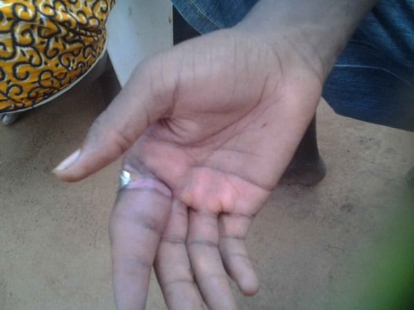 Ghana: une bague mystérieuse mange le doigt d'un jeune-homme (photos)